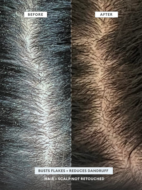 Briogeo Scalp Revival MegaStrength+ Dandruff Relief Shampoo Charcoal + AHA/BHA with Salicylic Acid 3%