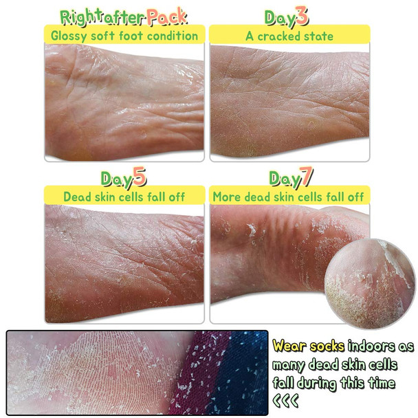 Elizavecca/Foot Peel /1 Foot Pack 2 Pairs Foot Mask  Boots for Exfoliating/foot pack review/foot pack before and after