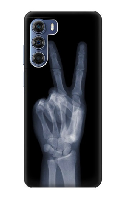 S3101 X線平和サイン手指 X-ray Peace Sign Fingers Motorola Edge S30 バックケース、フリップケース・カバー