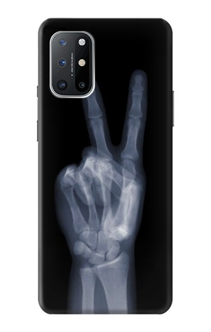 S3101 X線平和サイン手指 X-ray Peace Sign Fingers OnePlus 8T バックケース、フリップケース・カバー