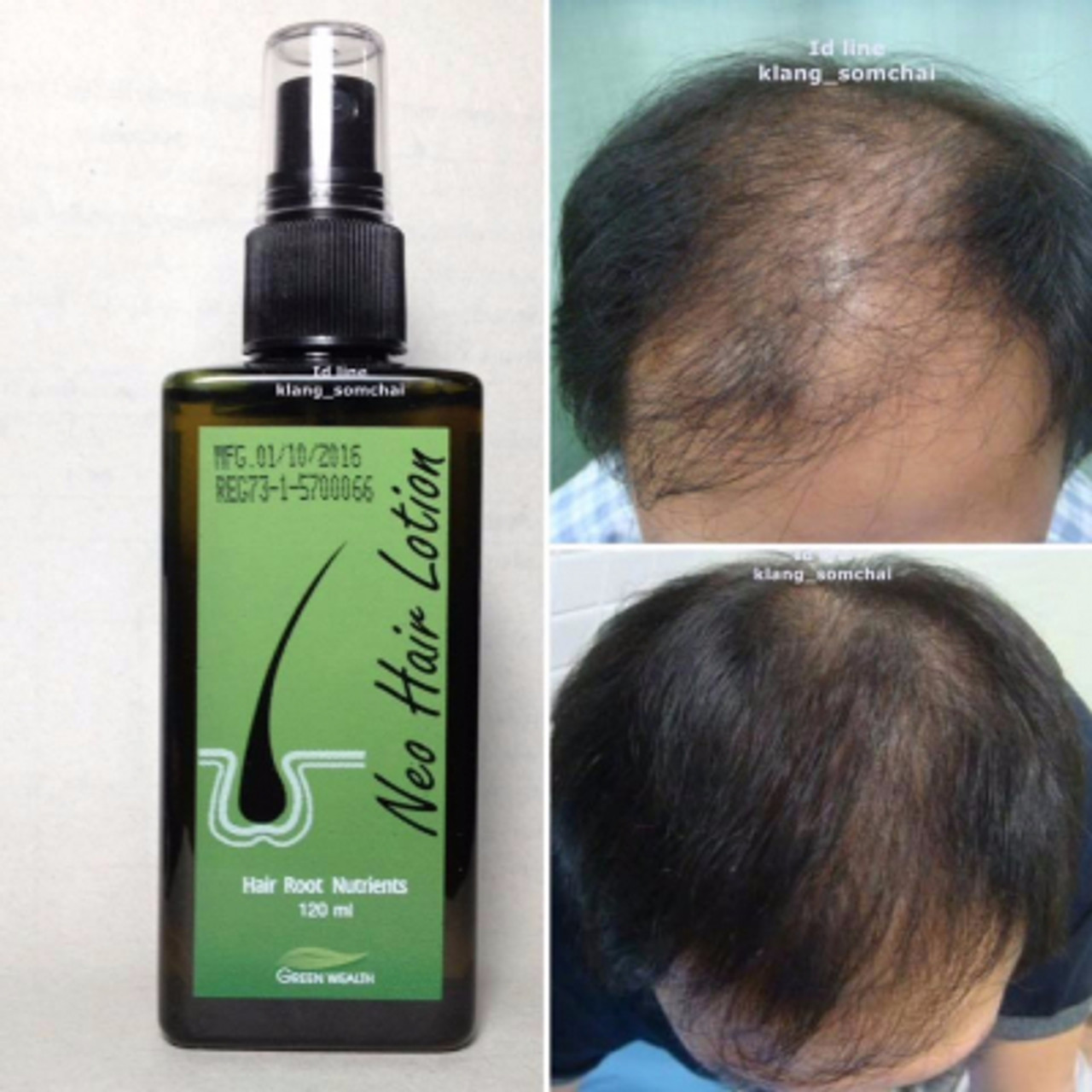 Neo hair lotion 3 Pcs , 100 Authentic 120ml worldwide delivery