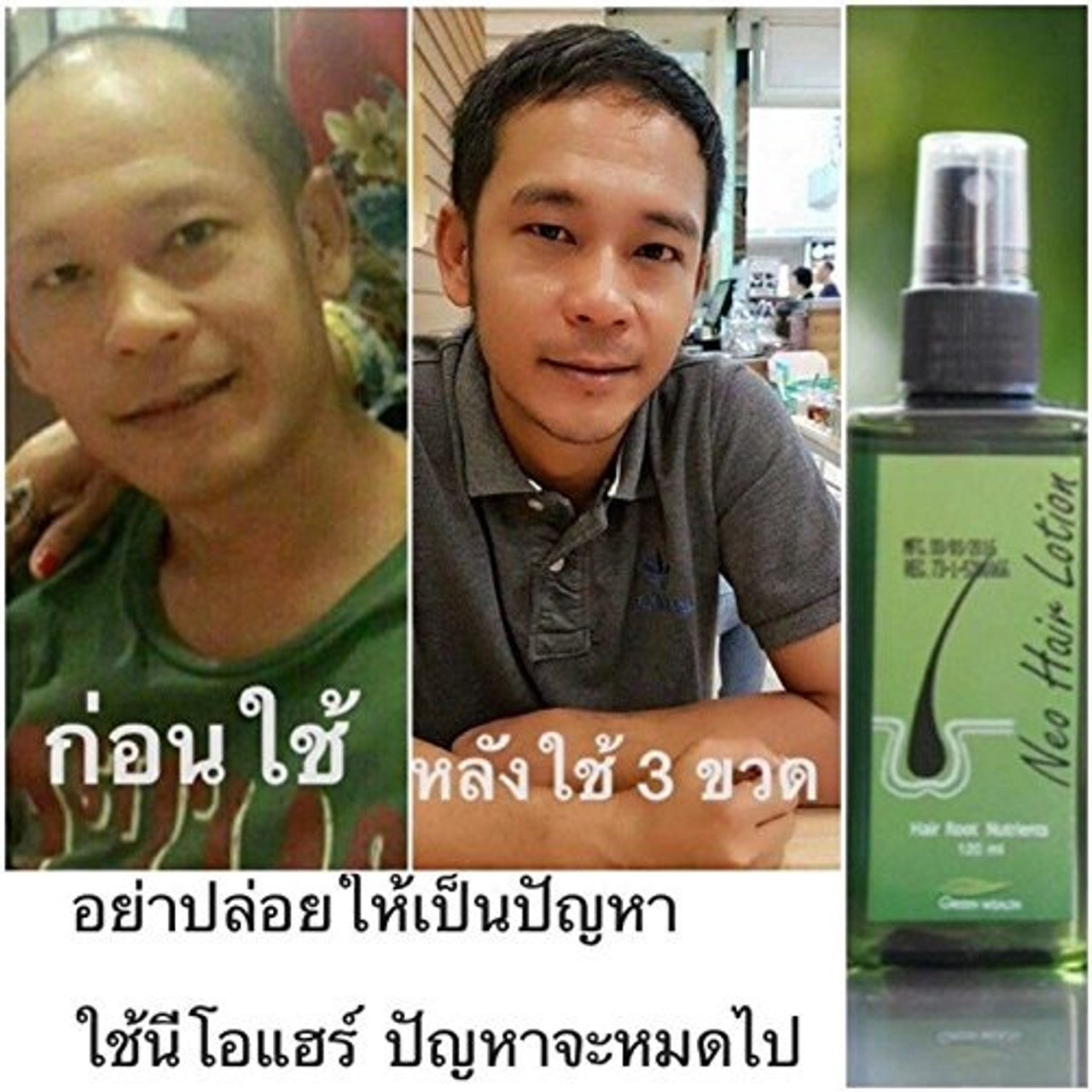 Thailand Ayurvedic Hair Loss Complete Treatment  Neo Hair Lotion Made in  Thailand