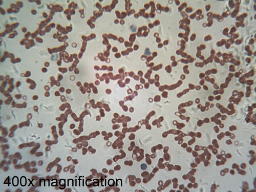 Human blood slide, anemia, smear