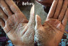 Karen's hands before using Nurturing Naturals eczema jam