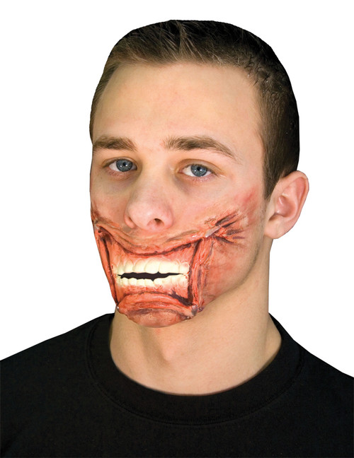 Stapled Mouth Appliance