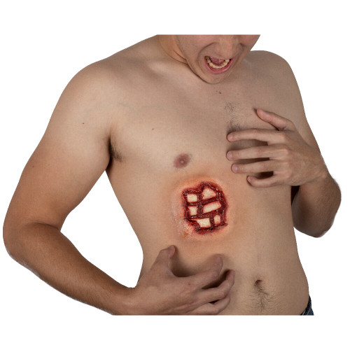 Appliance - Rib Injury Appliance - Rib Injury