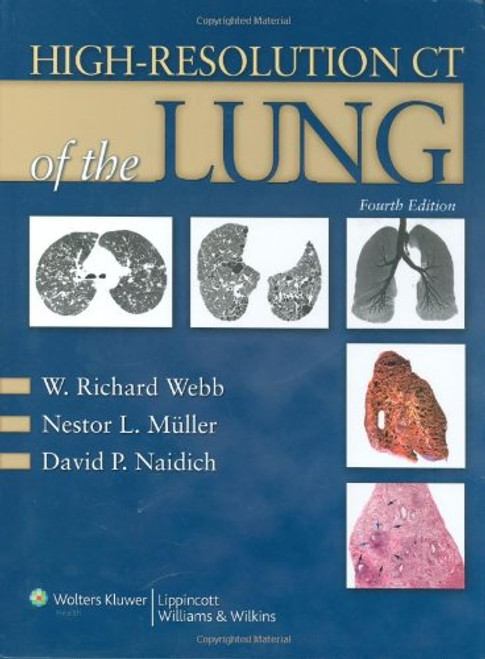 High-Resolution CT of the Lung