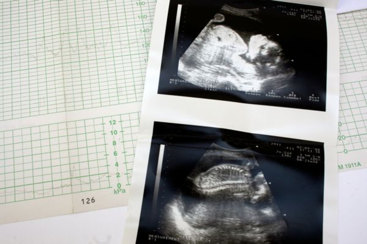 The Origination and History of Fetal Monitoring