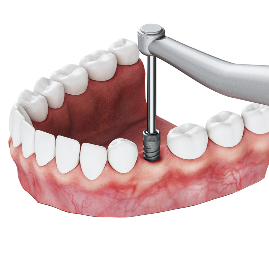 Implant Drivers 2.42