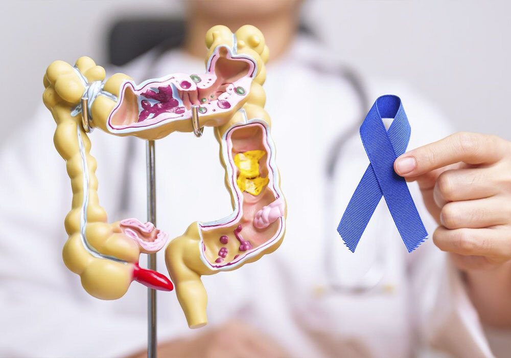 Campaña de prevención del cáncer de colon en Farmacia Granché en Sant Boi de Llobregat