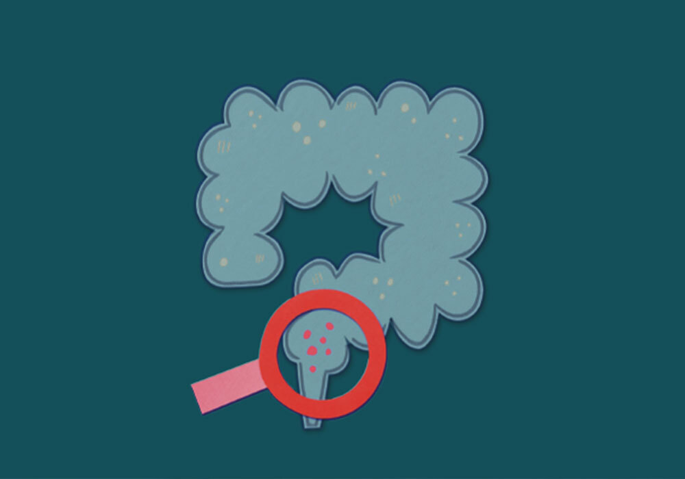 Campaña de prevención del cáncer de colon en Farmacia Granché en Sant Boi de Llobregat