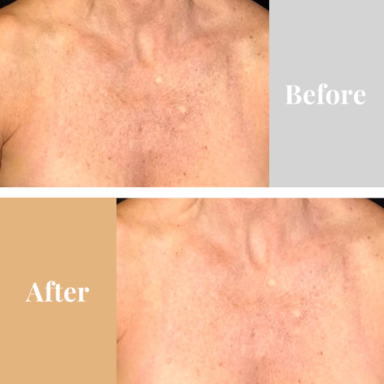 Omnilux Contour Neck & Décolleté Skin Truth