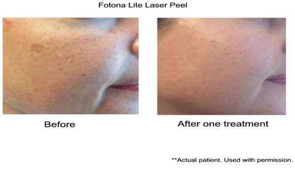 Laser Resurfacing for Dull & Uneven Skin Tone