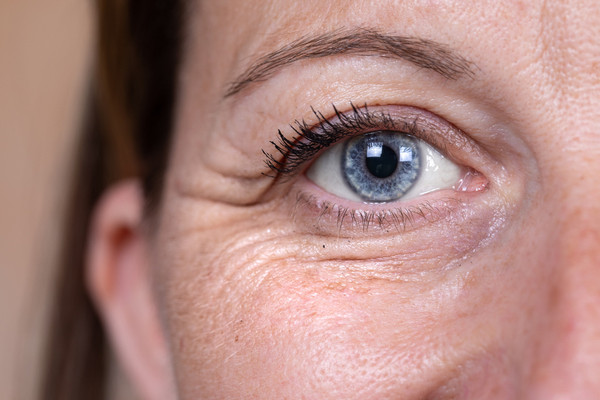 Wrinkle Resurfacing Eyes Or Mouth