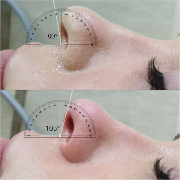 Fotona Nasal Lifting