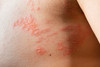 monkeypox rash
