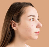 Five nutrition hacks to support acne