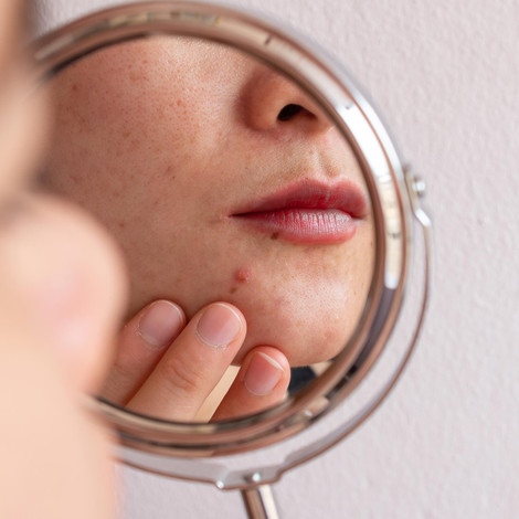 What is Cortisol Face?