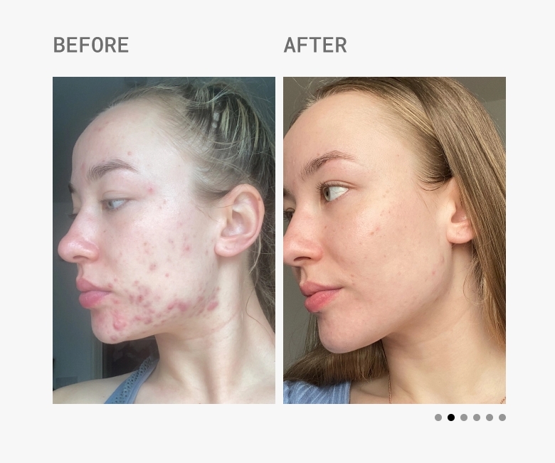 Skin Accumax Before & After