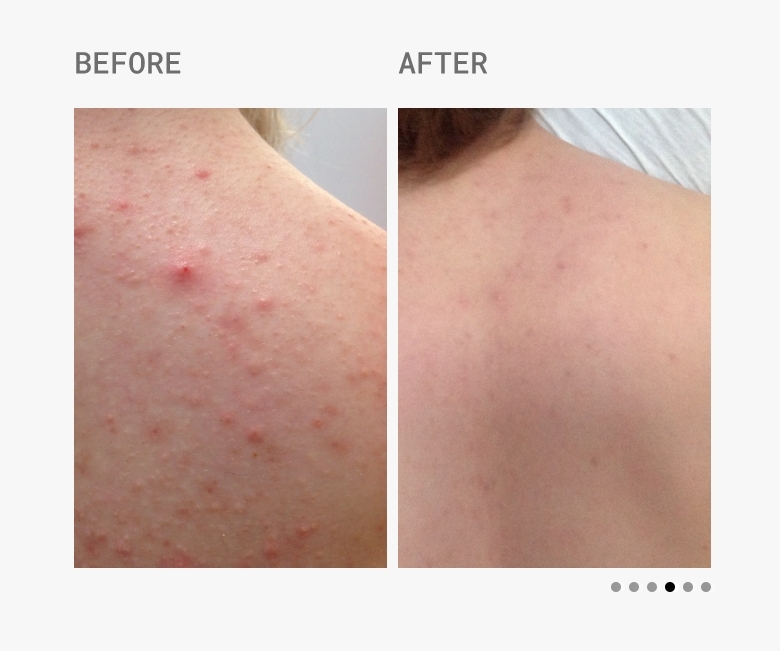 Skin Accumax Before and After