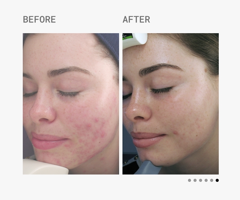 Skin Accumax Before & After