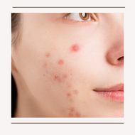 "Dear Courtney..." Protocol for 1st time Cystic Acne Client