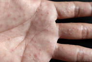 Dyshidrotic Eczema: A Skincare Herbalist’s Guide to Root-Cause Relief and Herbal Healing