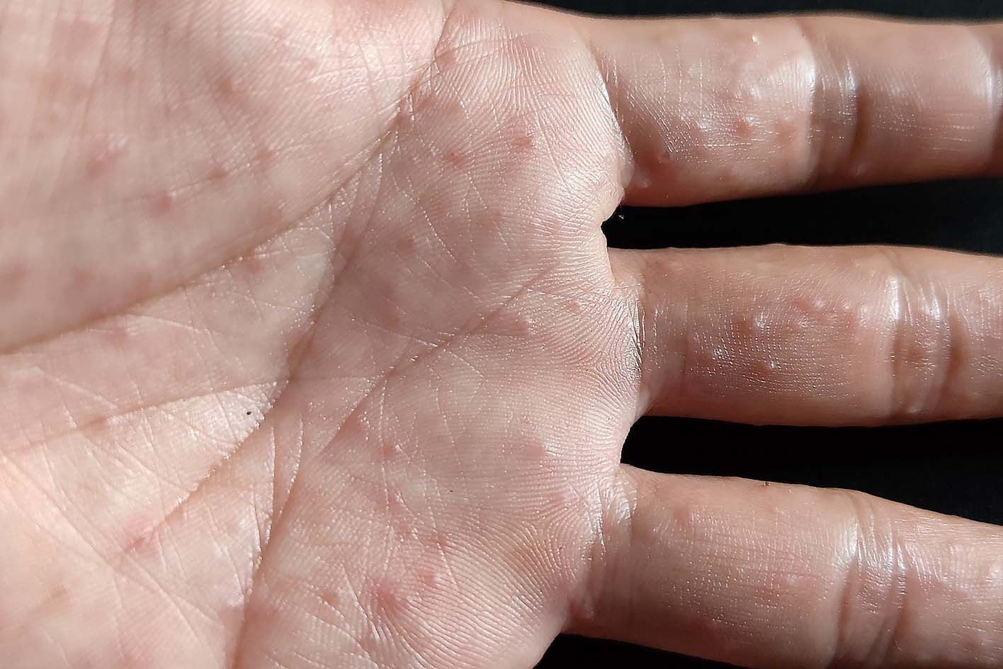 Dyshidrotic Eczema: A Skincare Herbalist’s Guide to Root-Cause Relief and Herbal Healing
