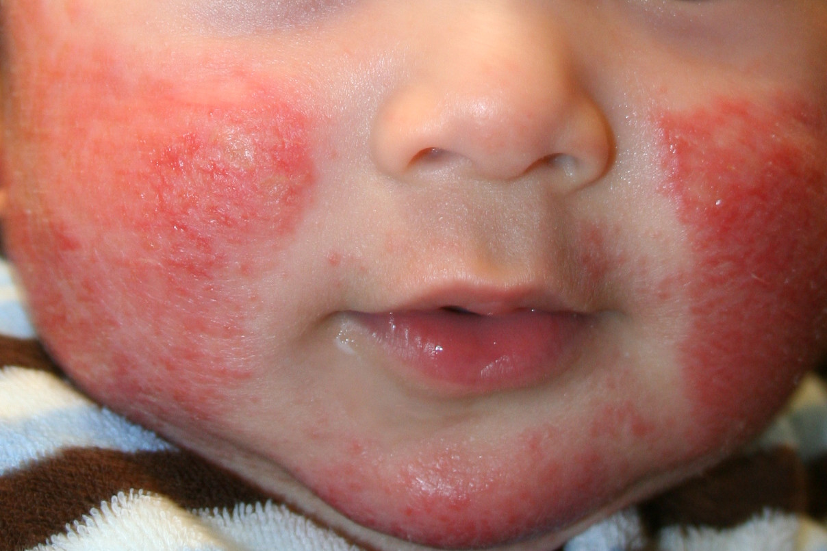 Chaffe Skin Chafed skin: Heat Rash, Chub Rub, areas that trap moisture... - Brazen Bee