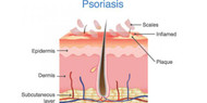 What I Have Learnt Since Having Psoriasis
