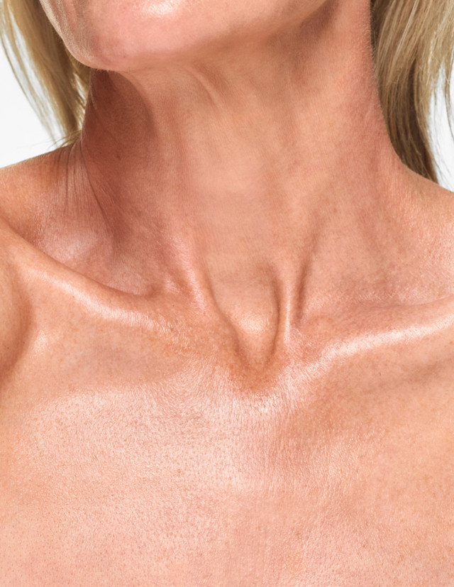 Laser Pigmentation Removal Decolletage product image