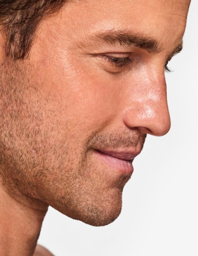 Laser Pigmentation Removal Nose product image