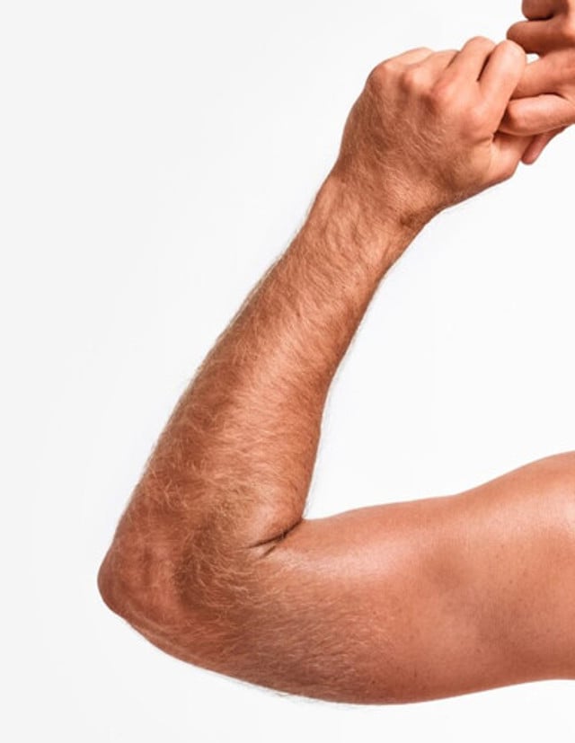 Laser Pigmentation Removal 1/4 Arms product image