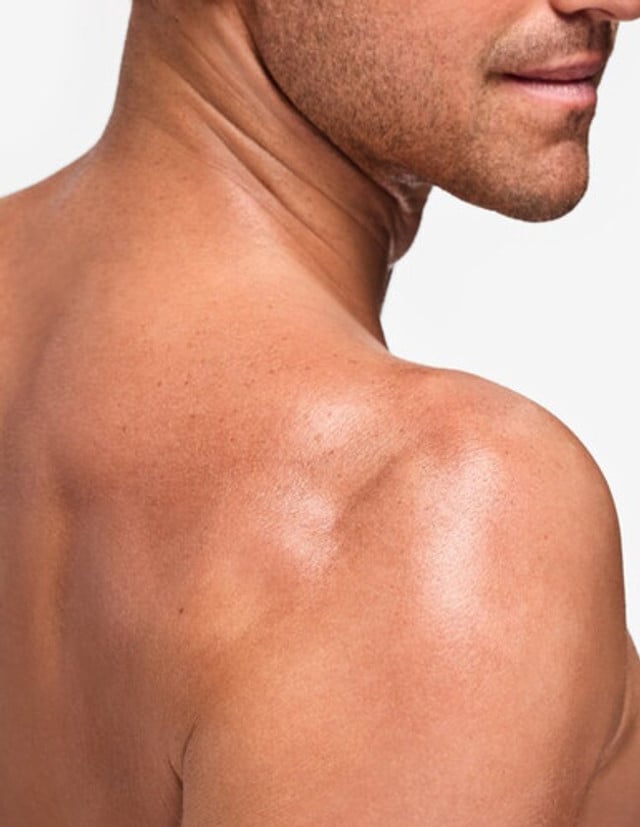 Laser Pigmentation Removal Shoulders product image