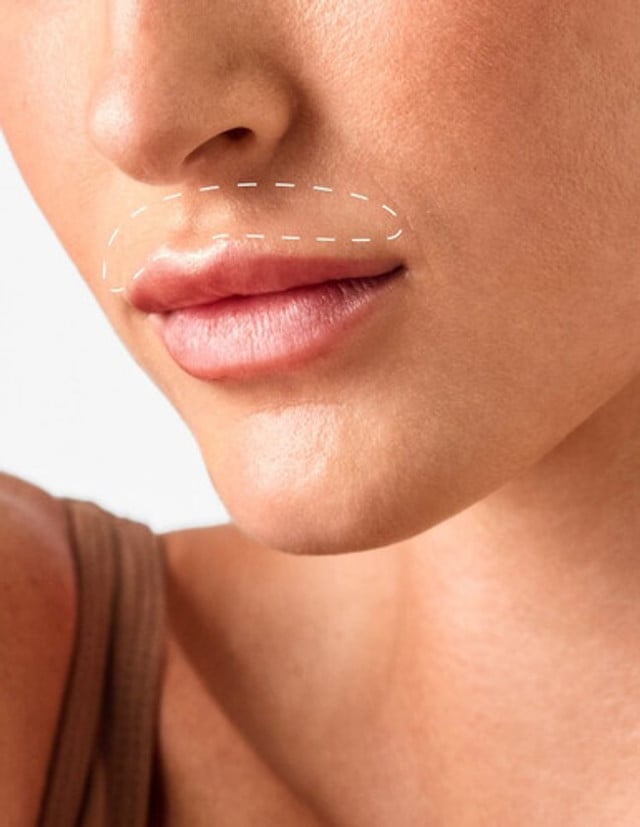 Lip - Laser Hair Removal product image