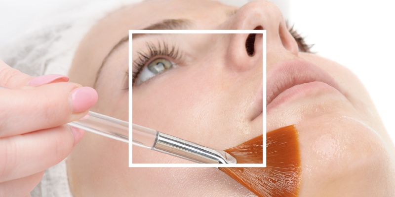 Chemical Peels