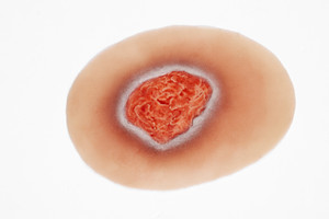 Medical Grade silicone wound, Pressure Injury - Stage 2. 01 light skin tone