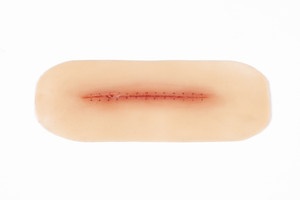 Medical Grade silicone wound, Dehiscence Small. 01 light skin tone