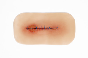 Medical Grade silicone wound, Suture Line Infected. 01 light skin tone