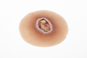 Medical Grade silicone wound, Pressure Injury - Stage 4. 01 light skin tone