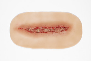 Medical Grade silicone wound, Dehiscence Medium. 01 light skin tone
