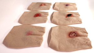 Pressure Injury Buttock Overlay Range