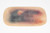 Medical Grade silicone wound, Closed fracture of Fibula.