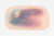 Medical Grade silicone wound, Large Haematoma. 01 Light skin tone