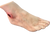Ulcerated foot