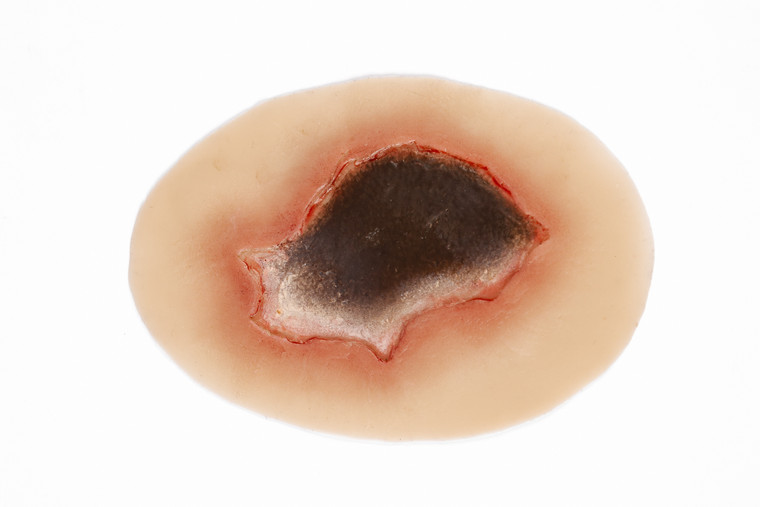 Medical Grade silicone wound, Pressure Injury - Unstageable. 01 light skin tone