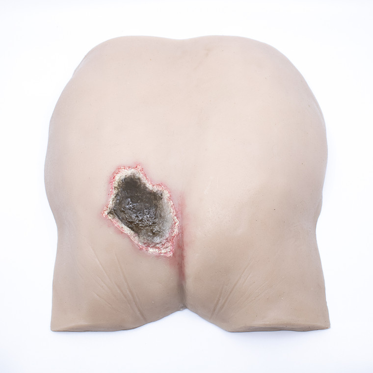 Perfect for students to get an understanding of the full 3-dimensional nature of Pressure Injuries and their stages. The Pressure Injury Buttock Overlay Unstageable is a realistic and durable silicone skin designed to lay over our Pressure Injury Foam Buttocks. Add realism to your training today! Available in 11 different colours.