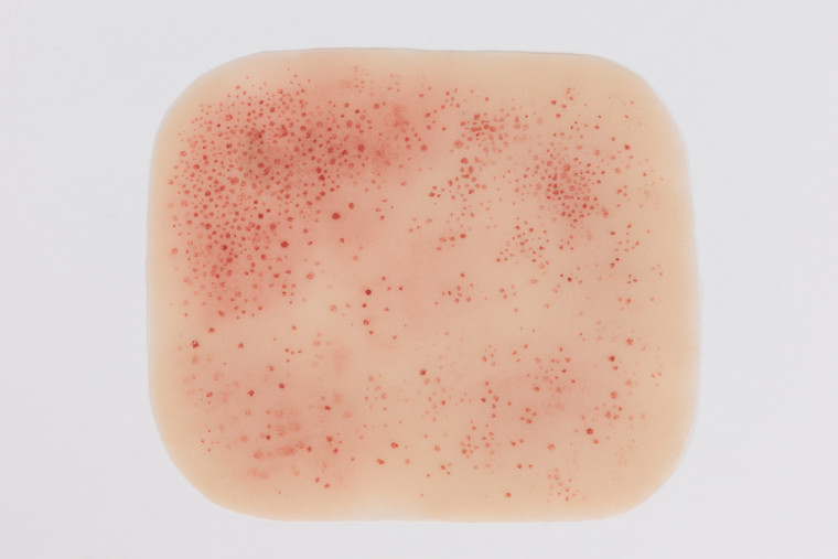 Medical grade silicone wound, Rash - Meningococcal. 01 light skin tone