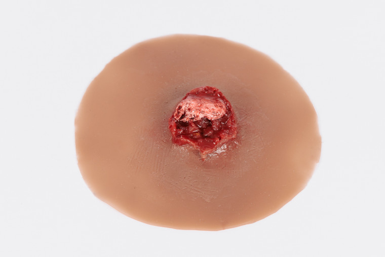 Medical Grade silicone wound, Compound Fracture Humerus. 08 tam skin tone