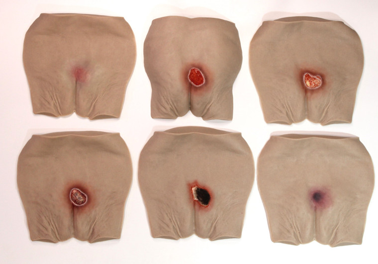 Pressure Injury Buttock Overlay Range